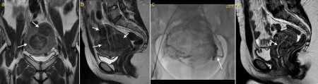 Uterine fibroid embolization