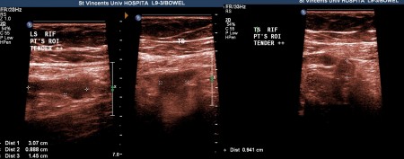 Acute appendicitis – US