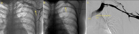 Upper limb DVT thrombolysis