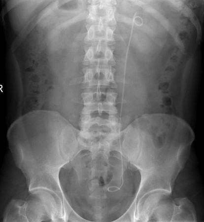 Ureteric stent
