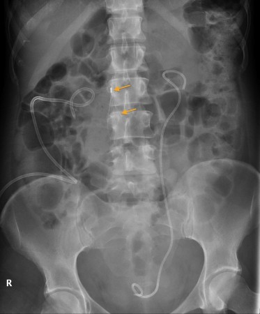 Ureteric stent