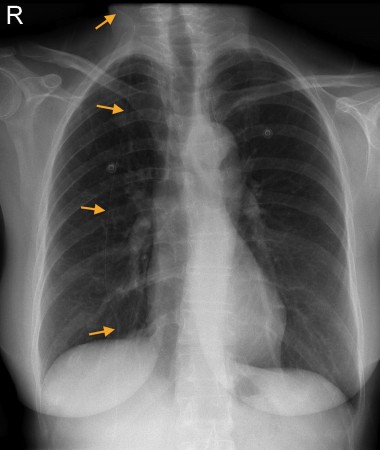 Ventriculoperitoneal shunt