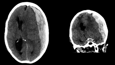 Acute subdural haematoma