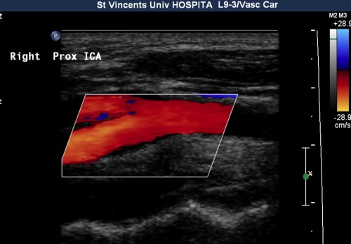 Doppler ultrasound of the carotid bifurcation.