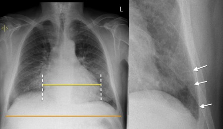 Congestive cardiac failure