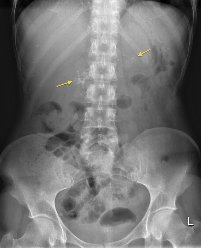 Chronic pancreatitis - Radiology at St. Vincent's University Hospital