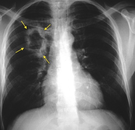 Cavitating lung cancer