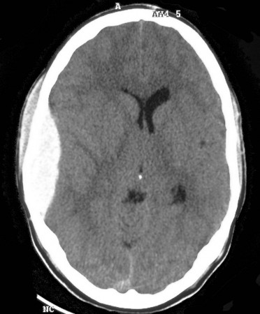 Extradural haematoma