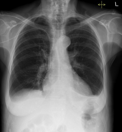 Pleural effusions