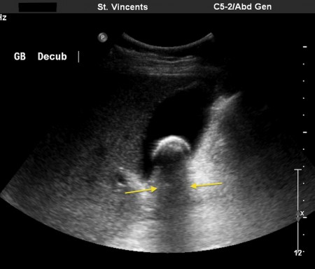 Gallstone – ultrasound