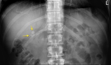 Gallstones