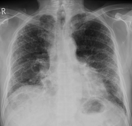 Pulmonary fibrosis