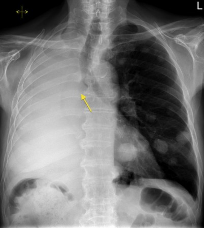 Metastatic lung cancer