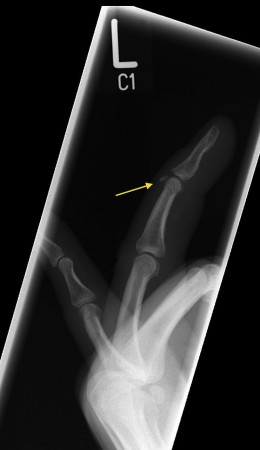 Mallet finger