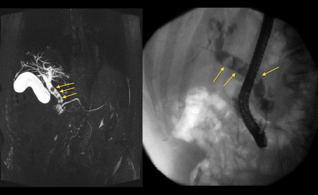 MRCP – choledocholithiasis - Radiology at St. Vincent's University Hospital