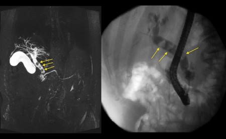 MRCP – choledocholithiasis