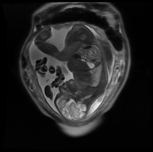 Coronal T2-weighted (note the bright amniotic fluid) MRI of a gravid uterus in a women who presented with abdominal pain in the third trimester of pregnancy. 