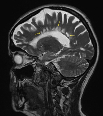 Multiple sclerosis