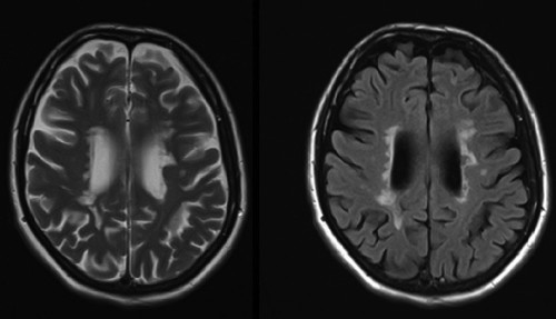 These two images are taken from an MR study in a patient with multiple sclerosis. The left-hand image is T2-weighted - note how bright the CSF is. On the right is a FLAIR image of exactly the same location - the high-signal periventricular demyelination plaques are far more obvious when we suppress the signal from the CSF.