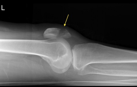 Patellar fracture