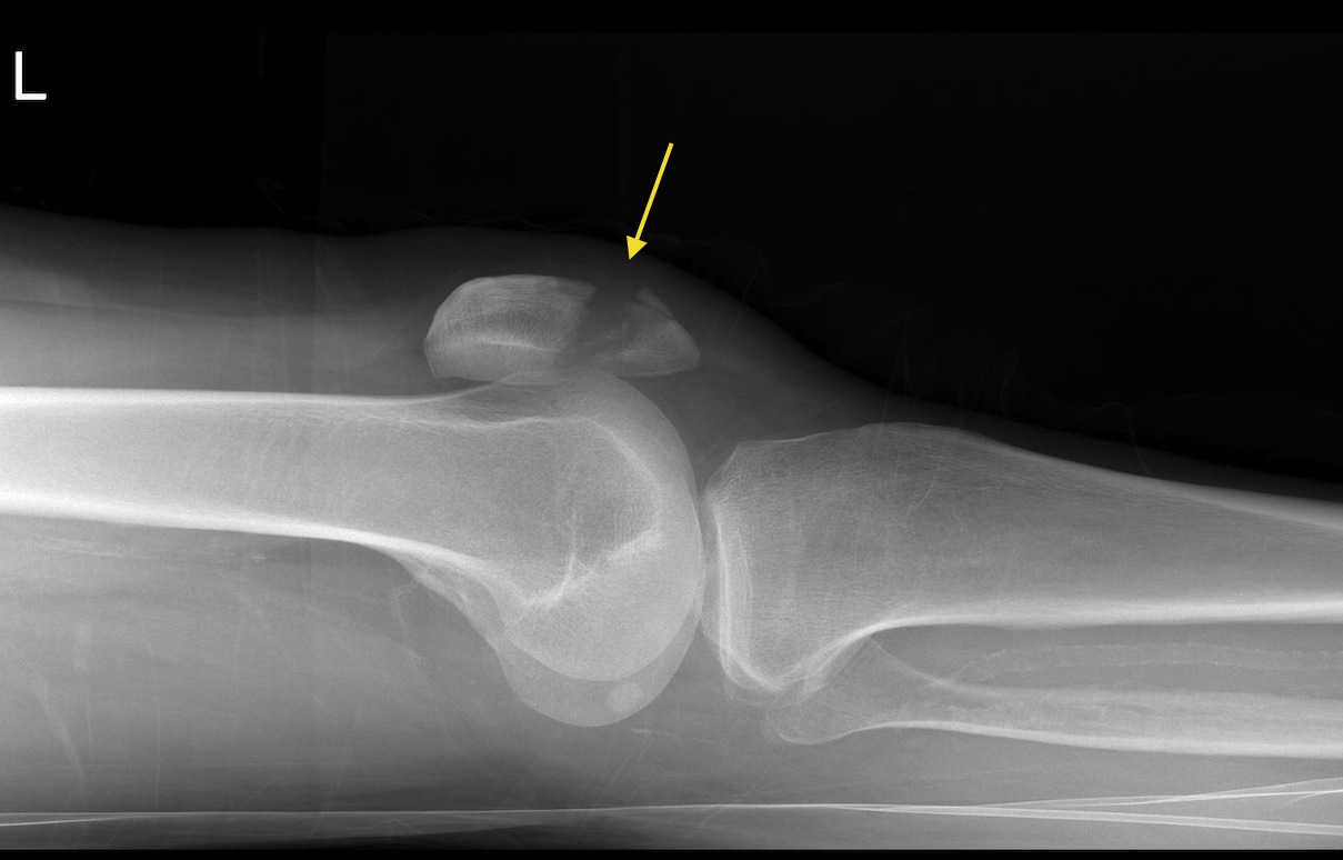 Patellar fracture - Radiology at St. Vincent's University Hospital