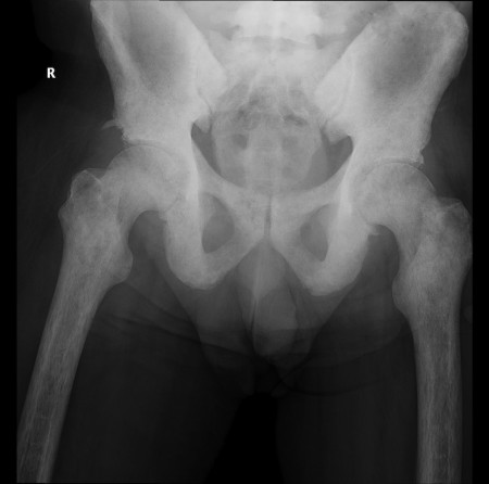 Prostate metastases