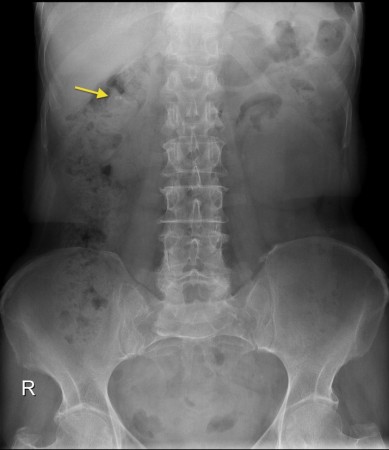 Renal calculus