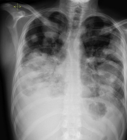 lung metastases radiology