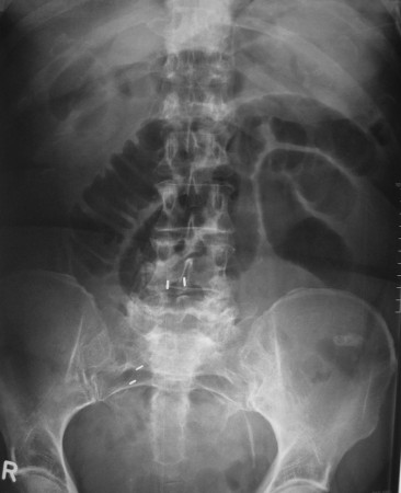 Small bowel obstruction