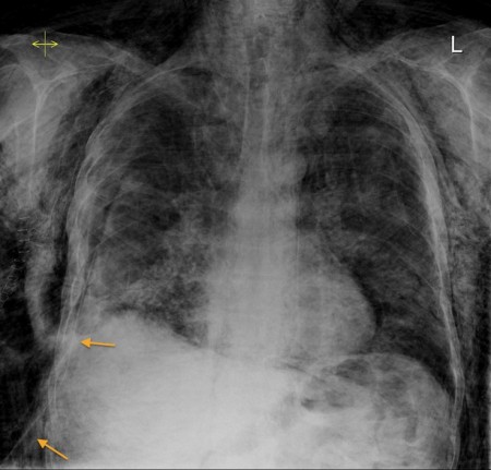 Surgical emphysema