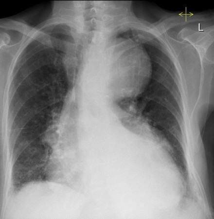 Thoracic aortic aneurysm