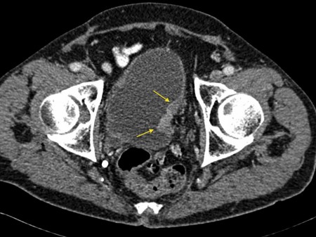 TCC bladder