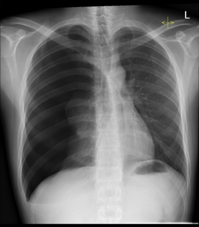 Tension pneumothorax