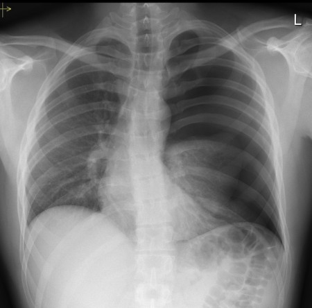 Tension pneumothorax