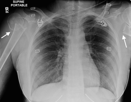 Humeral fractures on CXR