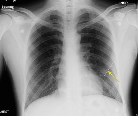 Penetrating chest trauma