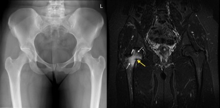 Stress fracture of femoral neck