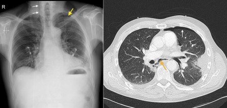 Boerhaave syndrome