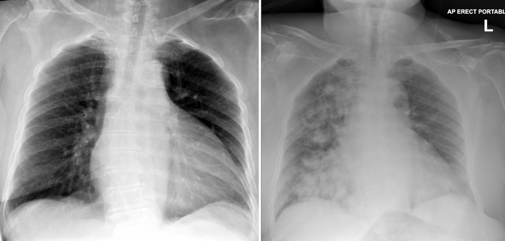 pneumonia chest x ray findings