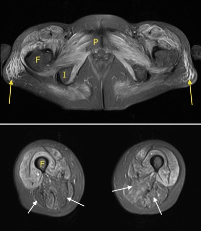 Dermatomyositis – MRI