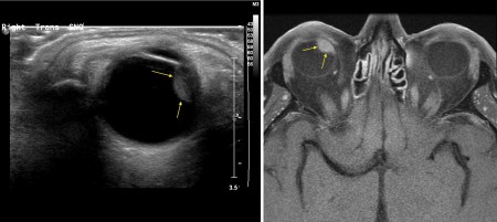 Ocular melanoma – US and MRI