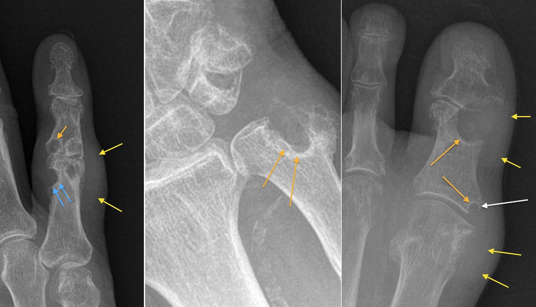 Gouty erosions Radiology at St. Vincent's University Hospital