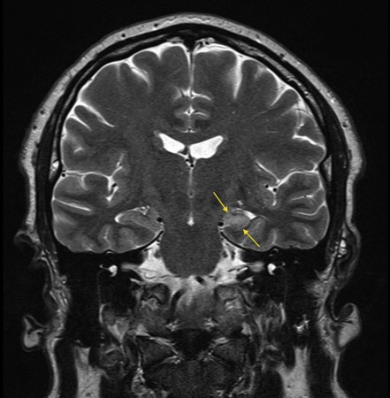 Mesial temporal sclerosis