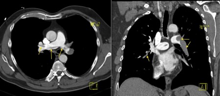 Saddle embolism