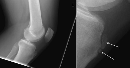 Osgood-Schlatter Disease