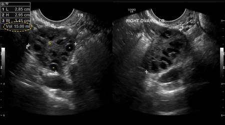 Polycystic ovarian syndrome