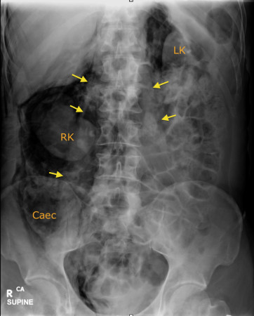 Retroperitoneal perforation