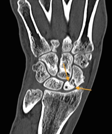 Scaphoid AVN – CT