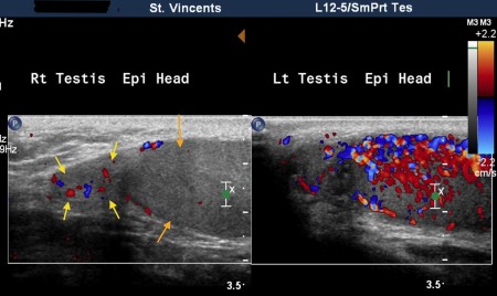 Epididymo-orchitis – ultrasound