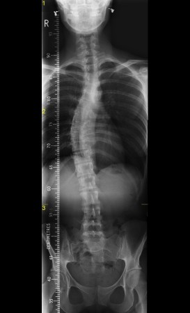 Scoliosis